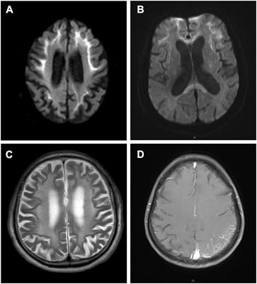 Urine cytological study in patients with clinicopathologically confirmed <mark class="highlighted">neuronal intranuclear inclusion disease</mark>